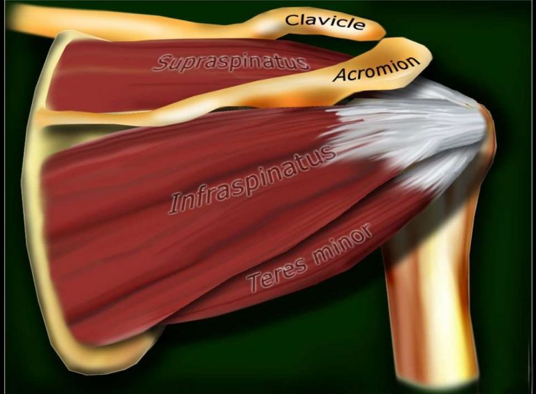 SUPRAspinatus Rotator Cuff Treatment - The Pain-FREE Shoulder Clinic ...