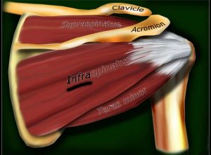 INFRAspinatus Rotator Cuff Muscle Tendon Injury Tear Treatment Dr. Bock Pain-FREE Shoulder Clinic